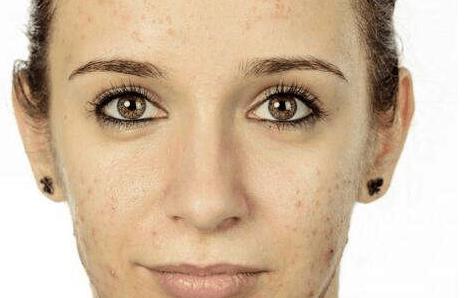 激素脸的色素沉着该如何修复,激素脸黑色素沉着多久恢复