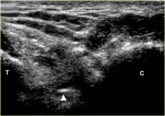 超声引导下穿刺手法解析,超声介入穿刺和普通穿刺的区别