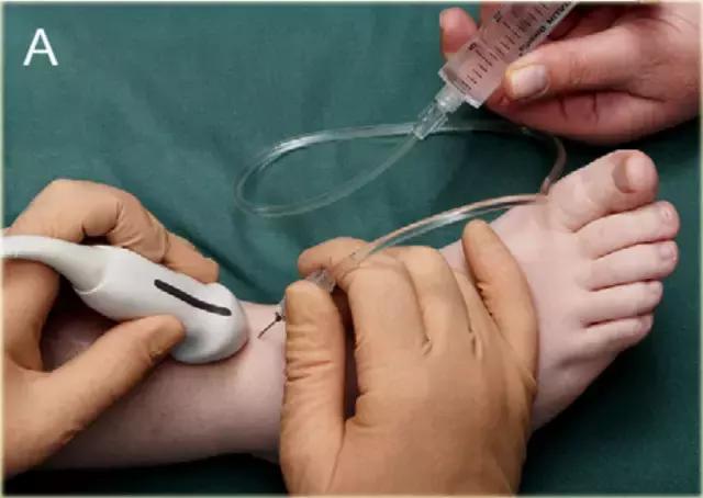 超声引导下穿刺手法解析,超声介入穿刺和普通穿刺的区别