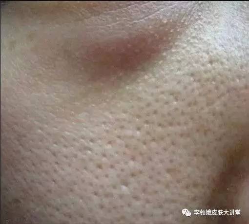 光动力治疗后的皮肤变化过程,光动力疗法和光动力治疗有啥区别