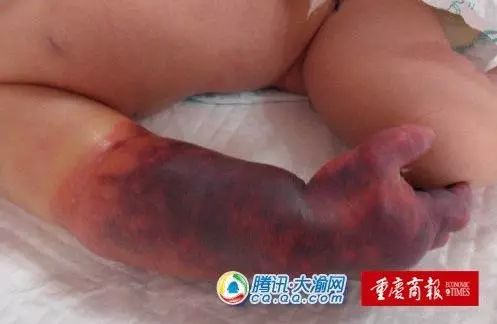 婴儿面临截肢,血泪的教训家长必知