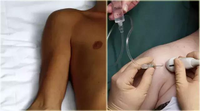 超声引导下穿刺手法解析,超声介入穿刺和普通穿刺的区别