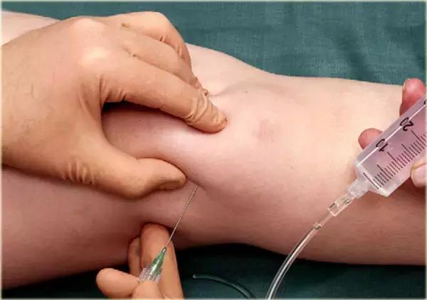 超声引导下穿刺手法解析,超声介入穿刺和普通穿刺的区别