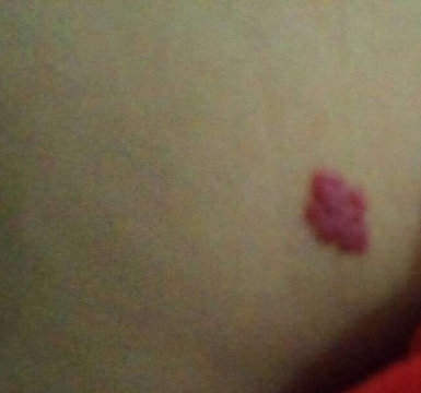 宝宝出生就有胎记是宝妈的原因吗,宝宝有胎记的宝妈们都去了吗