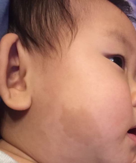 宝宝出生就有胎记是宝妈的原因吗,宝宝有胎记的宝妈们都去了吗