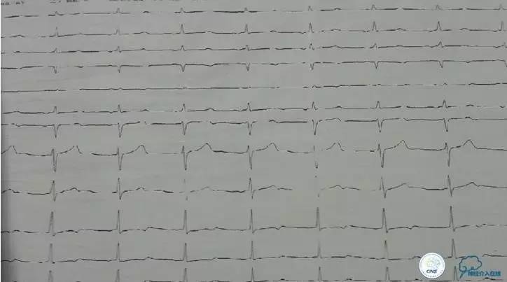 主动脉夹层引起的脑梗后遗症,颈动脉狭窄缺血性脑梗