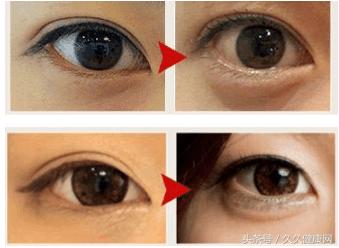 眼袋和卧蚕的区别教你区分小妙招,眼袋卧蚕最简单的辨别方法