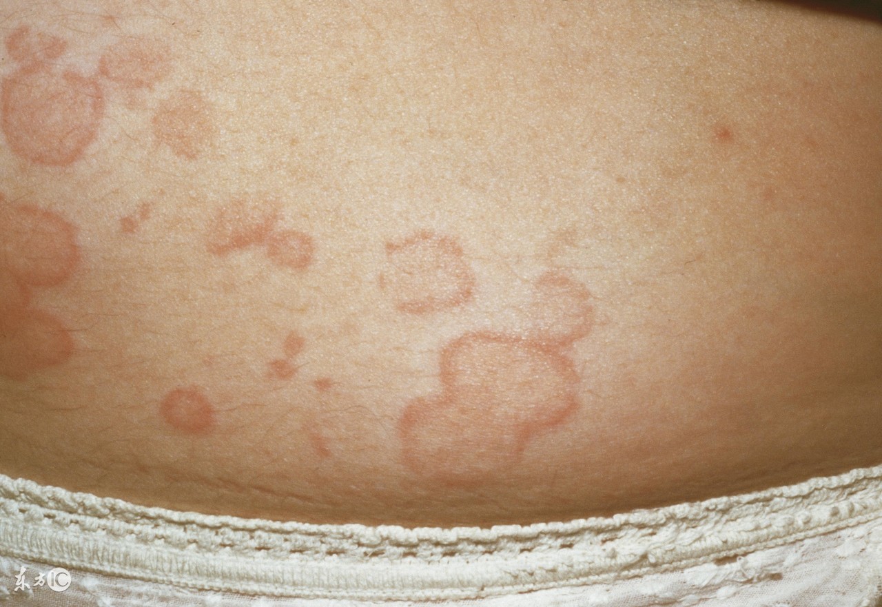 丘疹性荨麻疹可以打麻疹疫苗吗,丘疹性荨麻疹和麻疹应该怎么区分