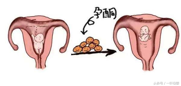 宫内孕6周孕酮6.98出血,孕酮偏低出血怎么办