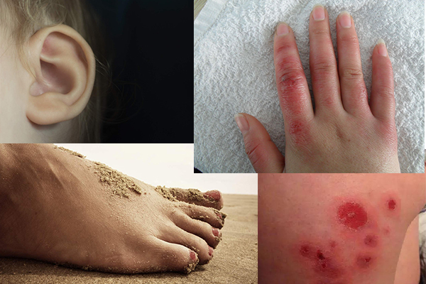 防止冻疮最好的方法,防止冻疮的最好办法