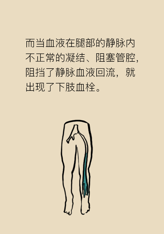 下肢血栓穿弹力袜的注意事项,下肢血栓穿的医用弹力袜怎么选