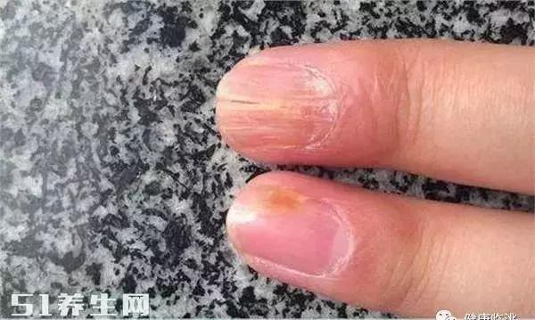 指甲有凹陷是什么原因引起的,中指甲凹陷是什么原因引起的