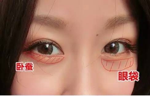 眼袋和卧蚕的区别看完你就知,卧蚕和眼袋的区别你知道吗