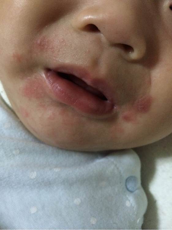 6个月宝宝嘴边眼睛周围有湿疹,6个月的宝宝嘴边起湿疹怎么办