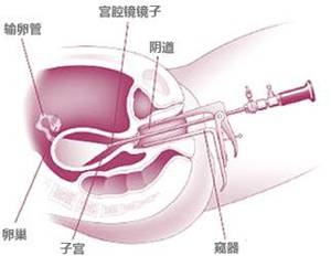 「又是“人流”惹的祸」发生子宫粘连怎么破？