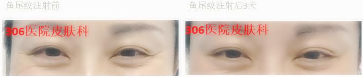 国家认可瘦脸针,军医扎针