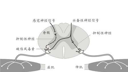 怎么预防破伤风最有效,受伤后怎样预防破伤风