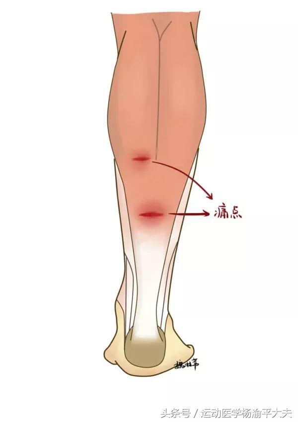听说过什么是网球腿吗？
