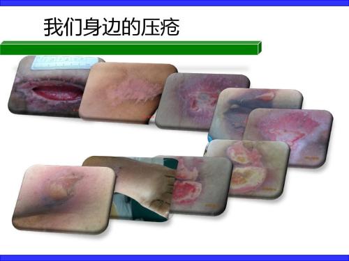 预防压疮最有效的护理措施是,预防压疮的护理湿热敷