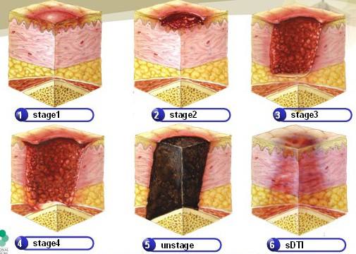 预防压疮最有效的护理措施是,预防压疮的护理湿热敷