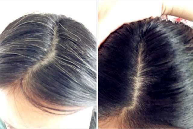 怎么知道少白头是由疾病引起的,男生少白头是什么原因导致的