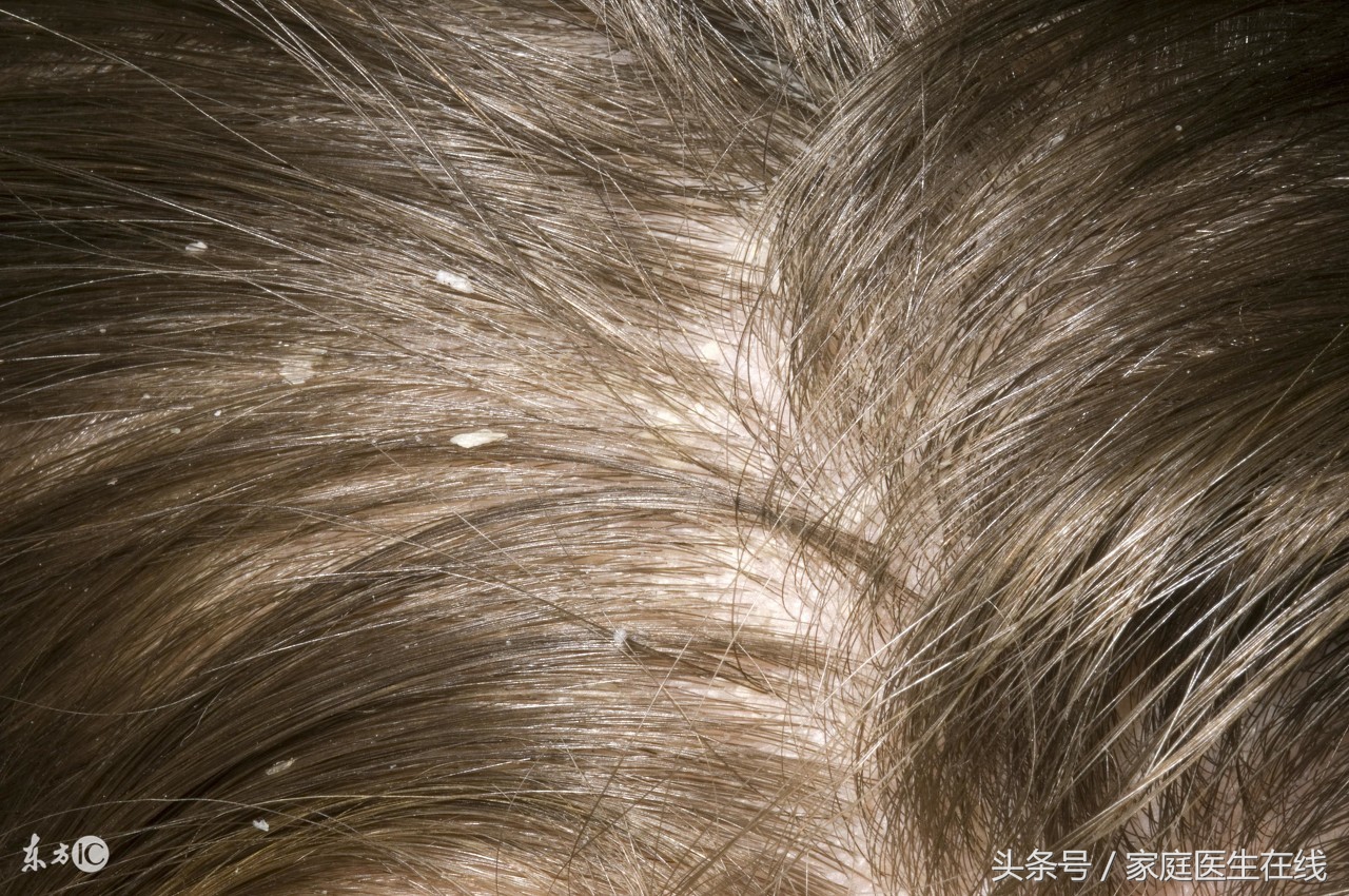 经常洗头头皮屑还是很多该怎么办,天天洗头头皮屑还是很多怎么办