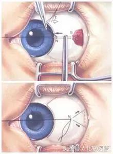 小孩歪头会导致眼睛斜视吗,儿童眼睛斜视眯着眼怎么导致的