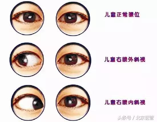 小孩歪头会导致眼睛斜视吗,儿童眼睛斜视眯着眼怎么导致的