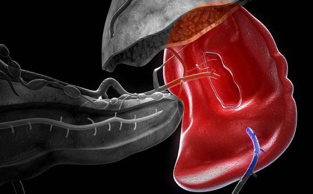 肝硬化脾大脾亢最多能活多久,丙肝引起肝硬化脾大脾亢