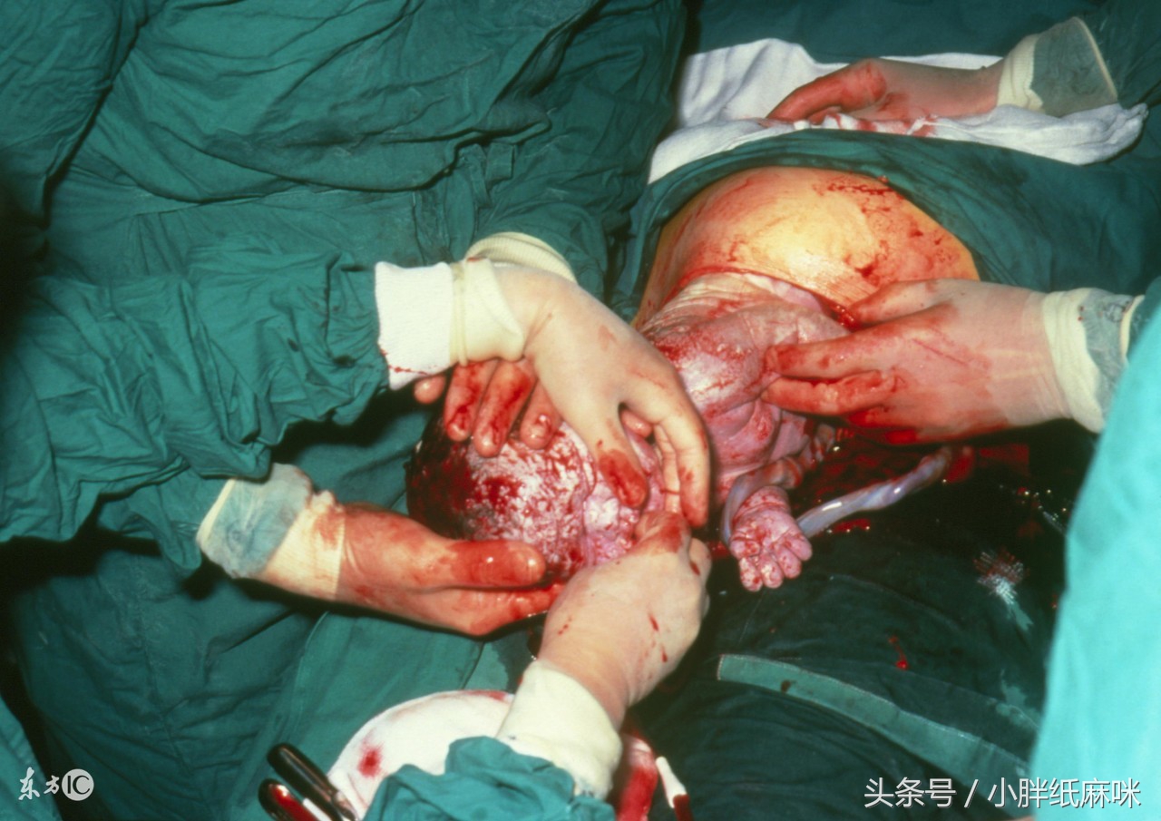 顺转剖你们还有母乳吗,生宝宝经历了顺转剖