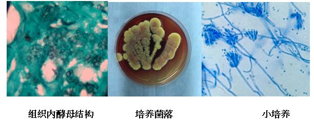 一个病例迸发大智慧！浙大一院皮肤科与北仑分院皮肤科联合在《新英格兰医学杂志》发表论文