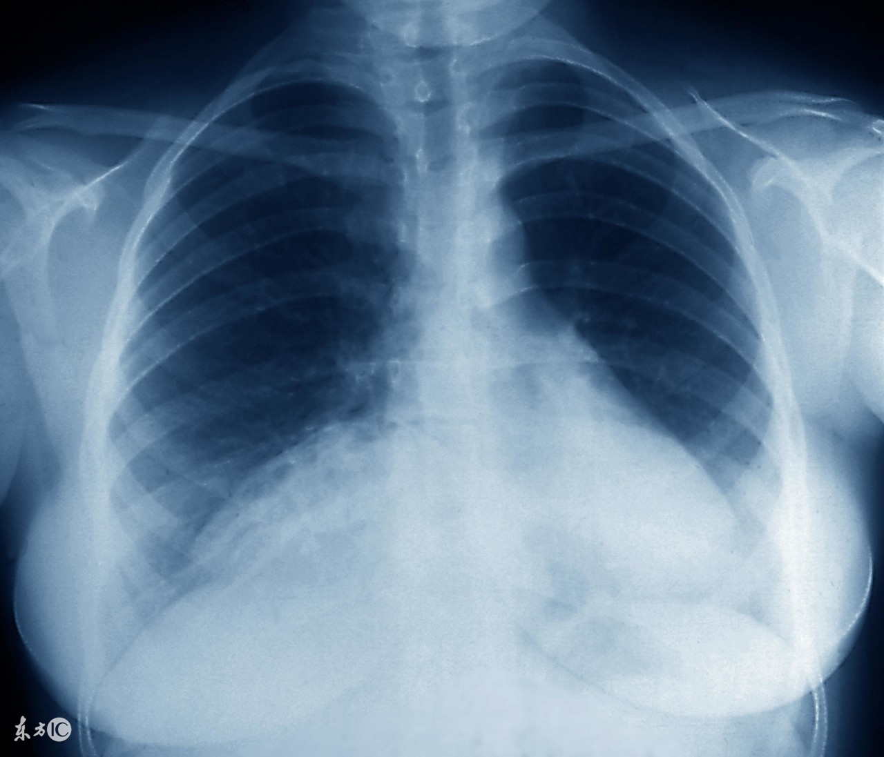 治疗支原体肺炎的有效措施是,肺炎支原体感染会反复交叉感染吗