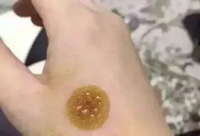 一块钱的红霉素软膏有什么功效,红霉素软膏为啥这么便宜