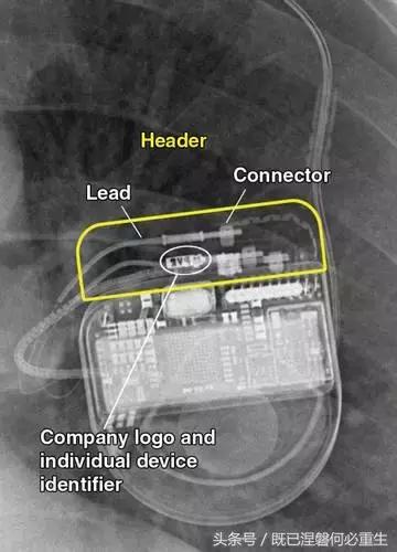 心内除颤仪和起搏器有什么区别,起搏器除颤仪