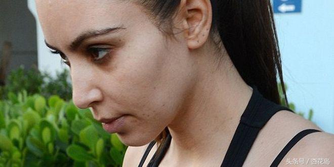 睡眠不足导致的黑眼圈怎么消除,长期睡眠不足的黑眼圈怎么消除