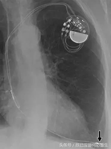 心内除颤仪和起搏器有什么区别,起搏器除颤仪