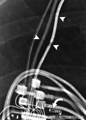 心内除颤仪和起搏器有什么区别,起搏器除颤仪