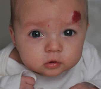 女孩子后背有胎记意义是什么,胎记的意义