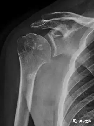 关节腔里长珍珠,关节附近长珍珠