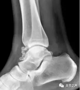 关节腔里长珍珠,关节附近长珍珠