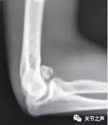 关节腔里长珍珠,关节附近长珍珠