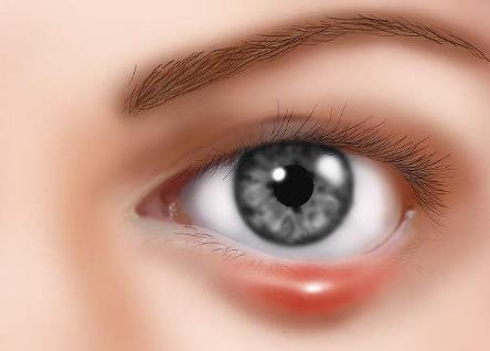 眼皮起麦粒肿什么病引起的,右眼长了麦粒肿有什么征兆