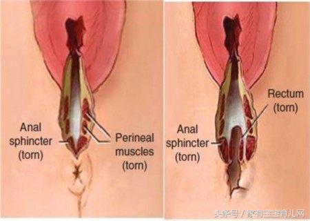 生产时，自然撕裂和侧切有什么不同？哪个恢复更快，该如何选择？