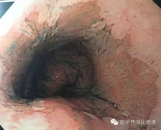 barrett食管的症状是什么,barrett食管是什么意思