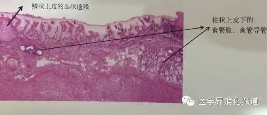 barrett食管的症状是什么,barrett食管是什么意思