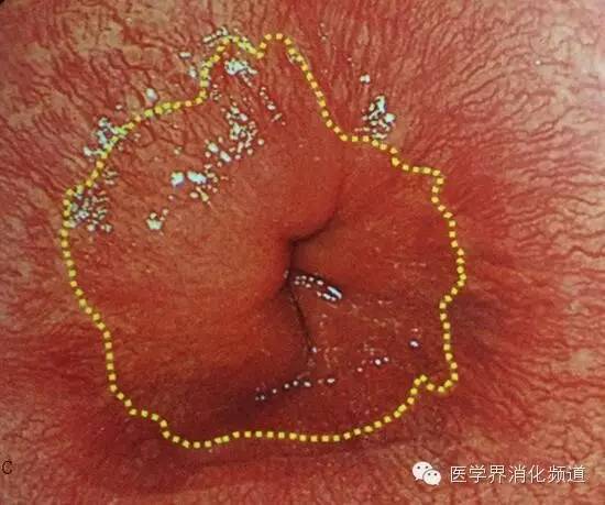 barrett食管的症状是什么,barrett食管是什么意思