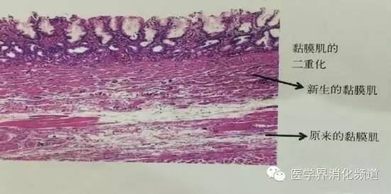 barrett食管的症状是什么,barrett食管是什么意思