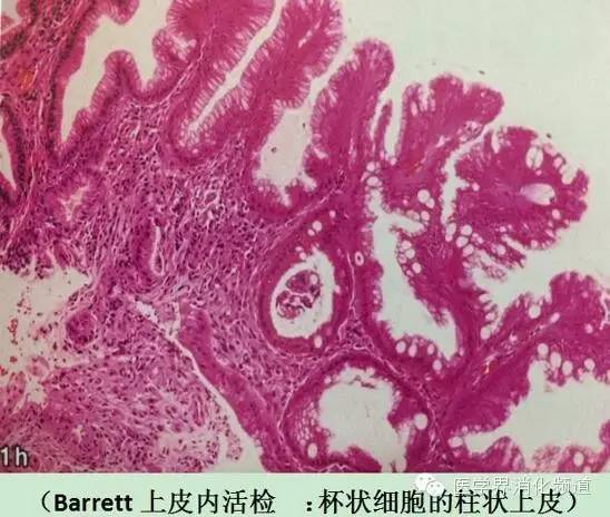 barrett食管的症状是什么,barrett食管是什么意思