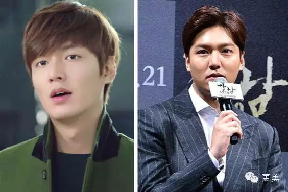 比超声刀更好的治疗方法,膨体隆鼻一年后鼻尖有个痘