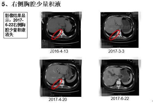 肺鳞癌能用nk细胞疗法吗,肺腺癌nkt治疗成功案例